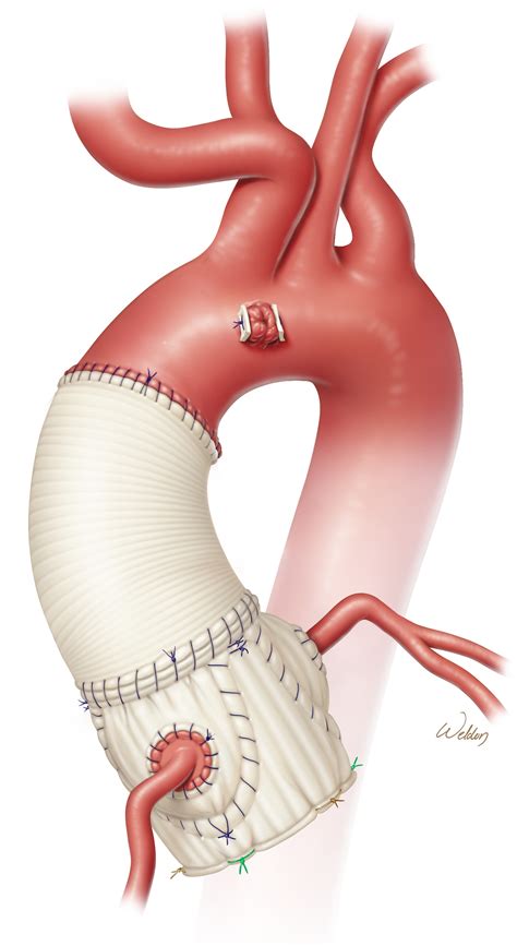 Straightforward Contemporary Step-by-Step Approach to Aortic Root Replacement With Valve-Sparing ...