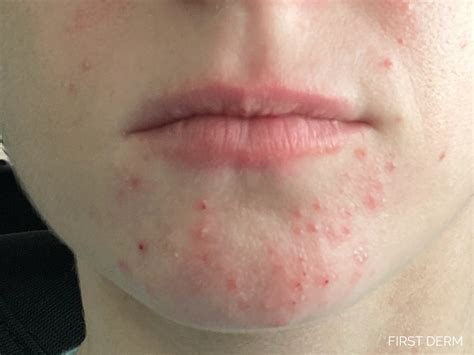 New FDA-Approved Treatment for Rosacea