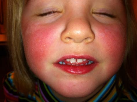 Warm Red Rash On Child's Face at Janice Kiefer blog