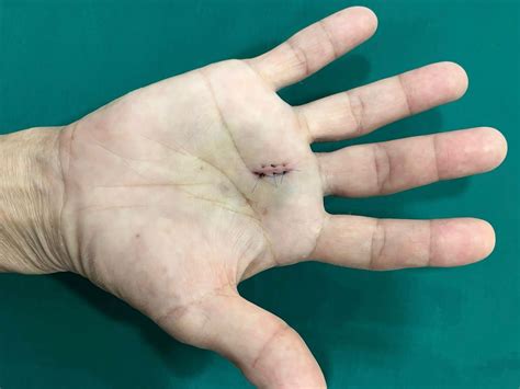 Trigger Finger Surgery | Trigger Finger Treatment in Singapore