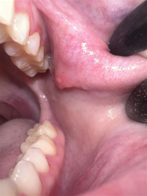 21F recent bloodwork fine, tissue bump in mouth with canker sore, cheek is sore, I’m scared the ...