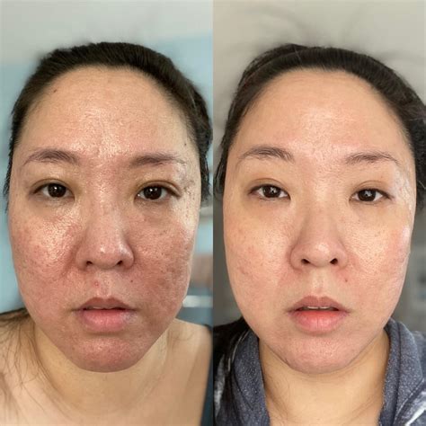 Can I Use Coconut Oil After Vitamin C Serum at Sandra Moody blog