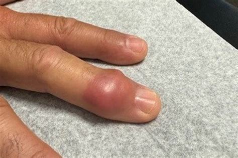 Finger Swollen Green _ Causes Of Finger Infection - QEKAE