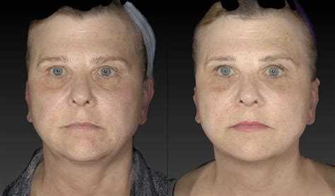 Fat Loss Red Light Therapy Weight Loss Before and After | Contours