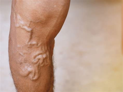 Spider Veins vs Varicose Veins: What's the Difference?