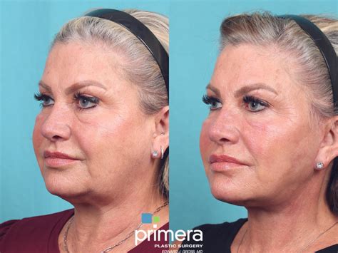 Mini Facelift Before and After Pictures Case 904 | Orlando, Winter Park & Tampa, Florida ...