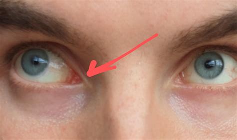 Lacrimal Caruncle Malignant Lesions Of The Caruncle | Eye