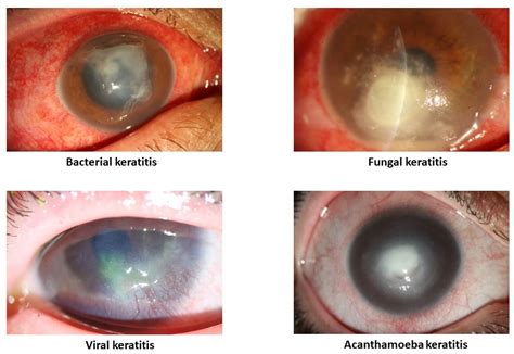 Keratitis