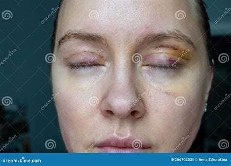 Swollen Face After Surgery