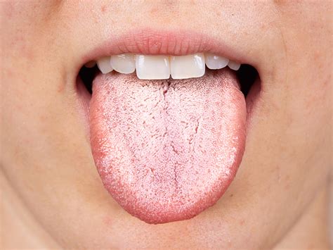 Tongue Dry Mouth 5 Most Common Causes Of Dry Mouth Affinity Health