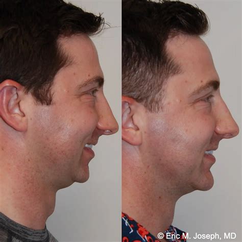 Jawline Exercises Before And After