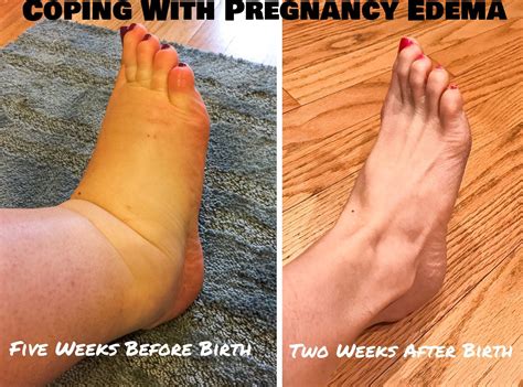 Feet Swelling After Birth