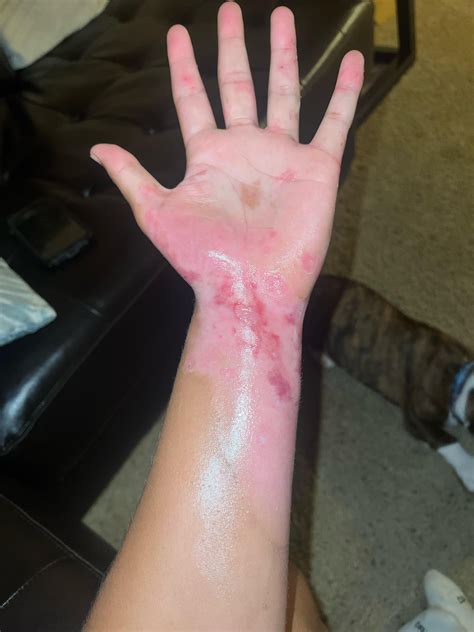 2nd degree burn : r/burnsurvivors