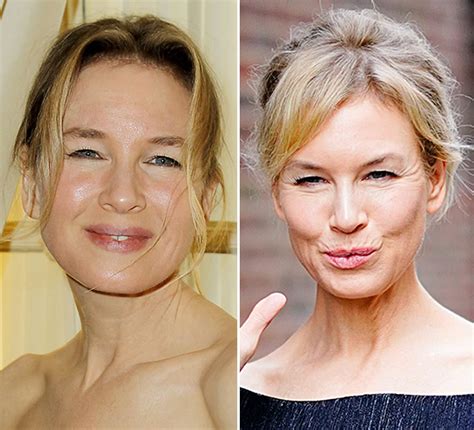 Renee Zellweger Plastic Surgery Before And After Pictures 2024 – AVKIU