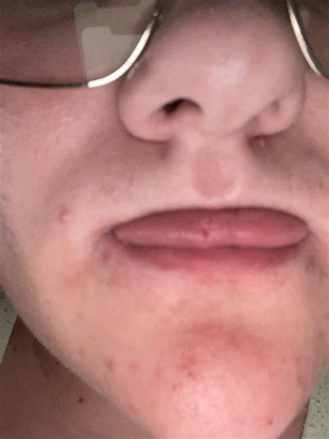 A lie bump on my tongue popped today : r/mildlyinfuriating