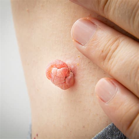 Skin Tag Removal Vs Wart Removal: Which Is Right For You?