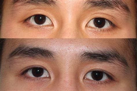 Double Eyelid Surgery Before And After Men - Infoupdate.org