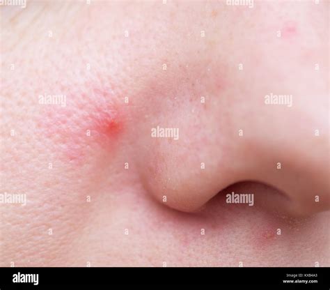 Red Bump On Nose