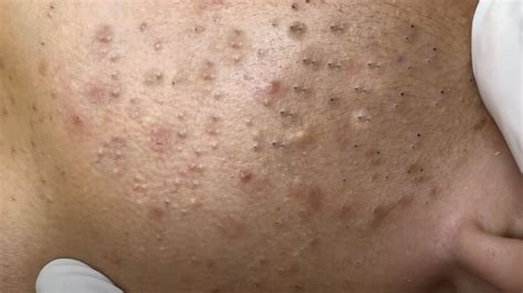 Extreme Blackhead Popping