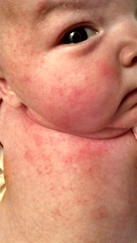 Infant Acne On Chest