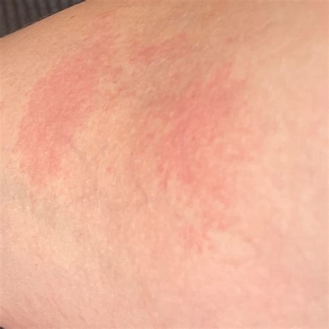 Dermatitis (ICD-10: L20) ⚠️ - Online AI Dermatologist