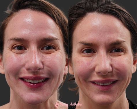 Botox Before And After