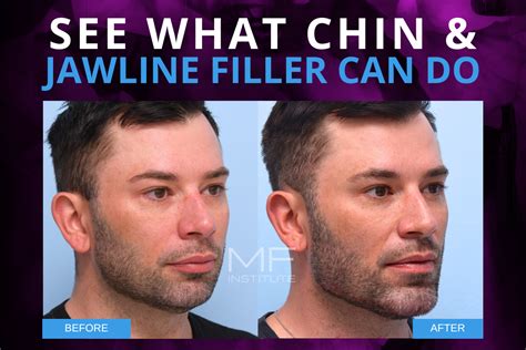 Chin and Jawline Filler: A Before and After Showcase of What’s Possible | Mabrie Facial Institute