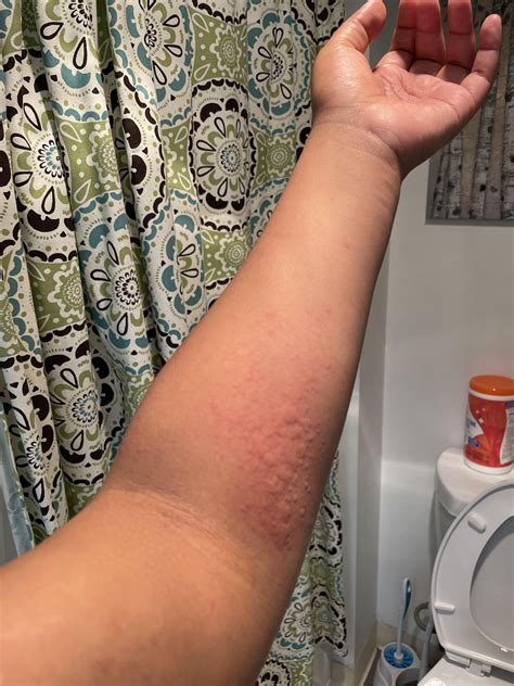 Breaking Out In Hives