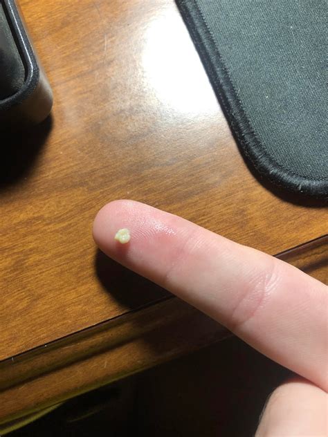 Popcorn Hull Stuck In Tonsil at John Heidt blog
