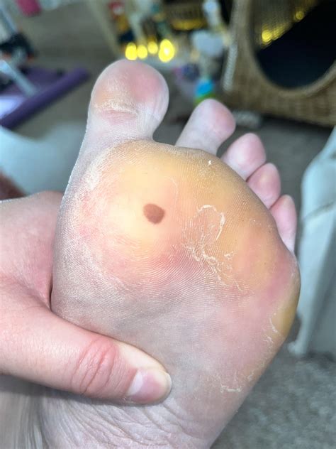 Mole/bruise on bottom of foot : r/Melanoma