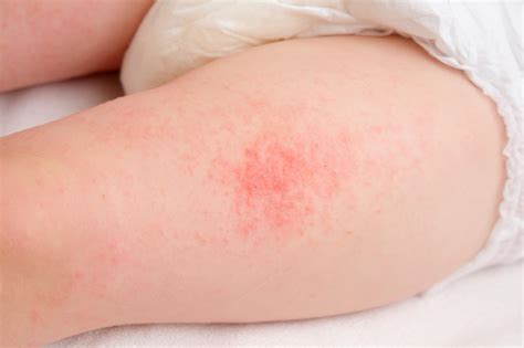 Eczema and Hives: Identifying and Managing Them Successfully