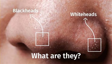 How To Remove Whiteheads