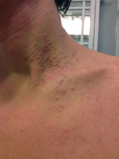 Treat Itchy Rash On Neck at Willard Madrigal blog