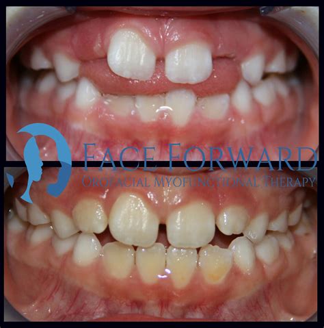 Tongue Posture/Tongue Thrust — Face Forward