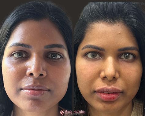 Under Eye Fillers - Before & After Results at Skinly