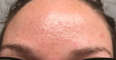 Forehead Bumps Fungal : Folliculitis On Forehead Causes: Symptoms And Treatment Options – ICKAH