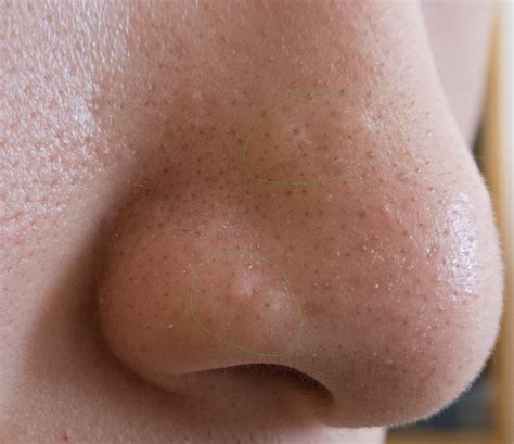 Best Of The Best Tips About How To Get Rid Of Bumps On Your Nose - Tapmill