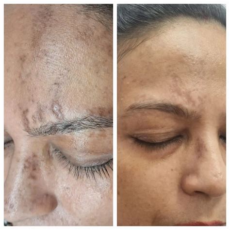 Best Acne Scars Treatment in Kolkata - Cost, Procedures & Results - La Derma
