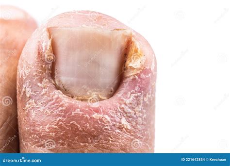 Closeup of Painful Inflammed Infection of the Big Toe Due To Ingrown Toenail Stock Photo - Image ...