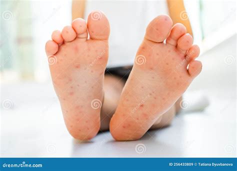 Enterovirus Leg - Arm - Mouth. Rash on the Body of a Child. Cocksackie ...