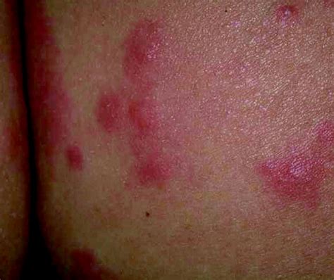 8 Management of allergy, rashes, and itching | Emergency Medicine Journal