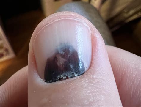 Crushing of the thumb, with subungual hematoma.