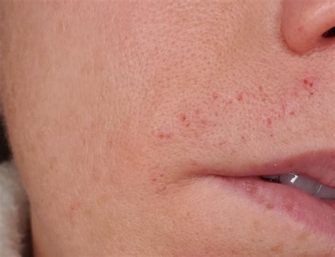 Red Spots On The Upper Lip - Infoupdate.org