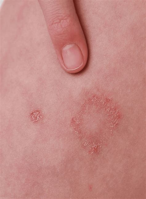 Bacterial Skin Infections | Thomson Medical