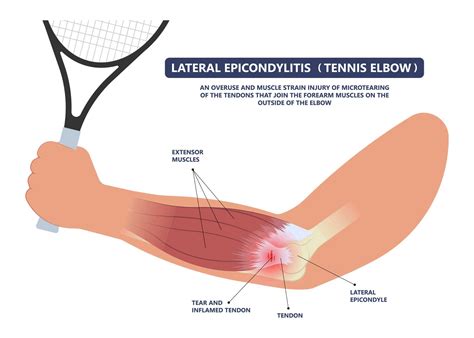 TENNIS ELBOW (LATERAL EPICONDYLITIS) - MOTUS Physical Therapy