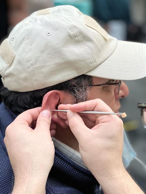Ear Seeding Acupressure at Santa Clara Acupuncture, San Jose on 13th December, 2022