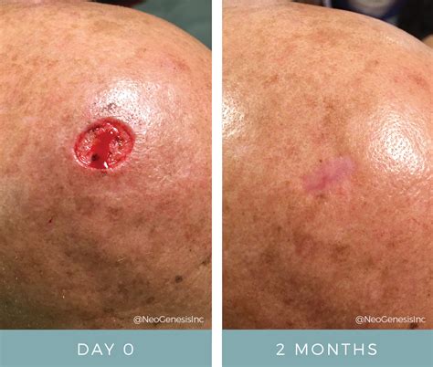 Mohs Surgery for Skin Cancer Before + After NeoGenesis Products