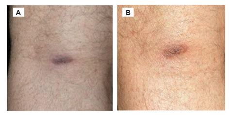 Presentation of Acrodermatitis Chronica Atrophicans Rashes on Lyme ...
