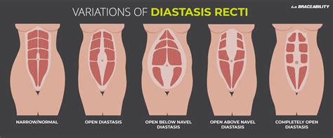 Diastasis Recti Pain In Ribs | Understanding Diastasis Recti: Causes, Symptoms, and Exercises ...