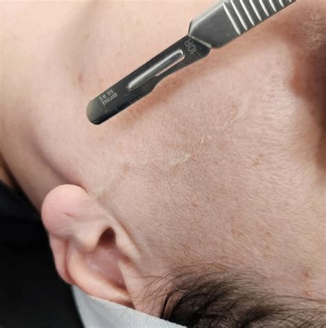 How Long Does Dermaplaning Last?